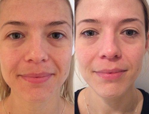 Hydra Facial
