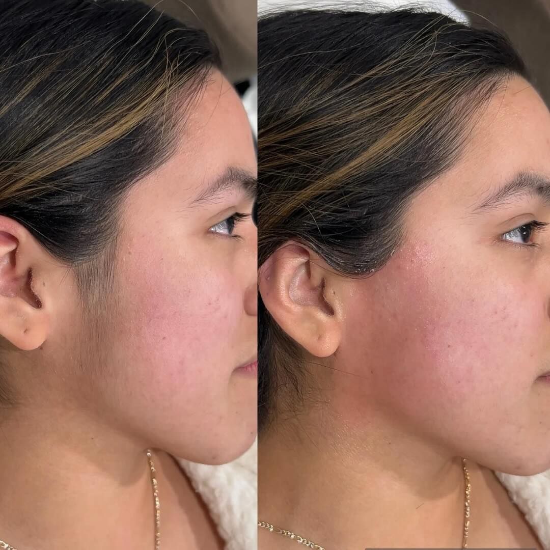 Laser Hair Removal Result