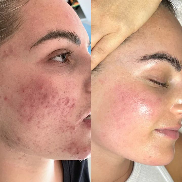 Acne Result