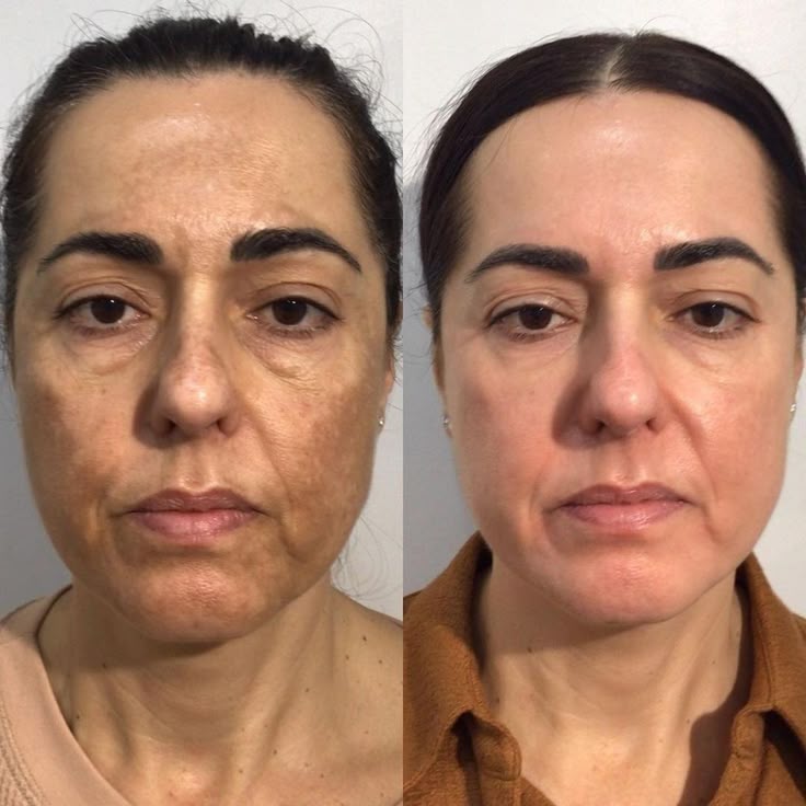 Anti Aging Result