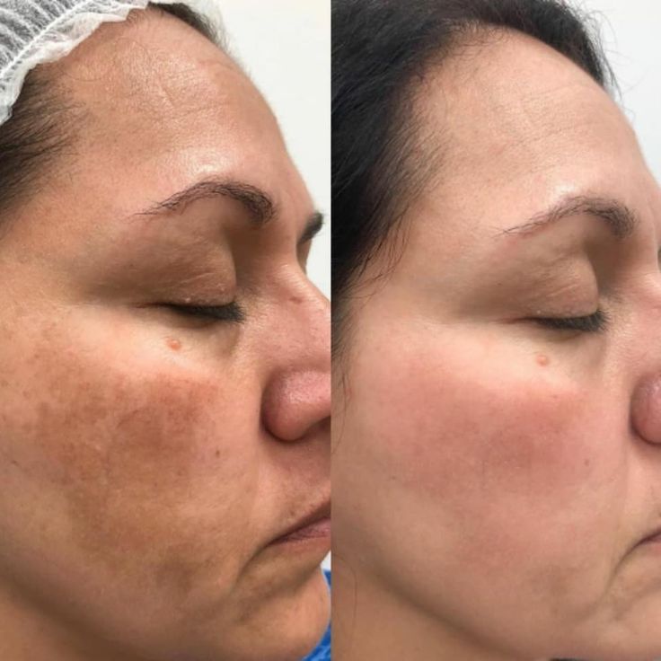 Pigmentation Result